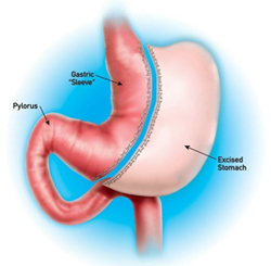 Vertical Sleeve Gastrectomy