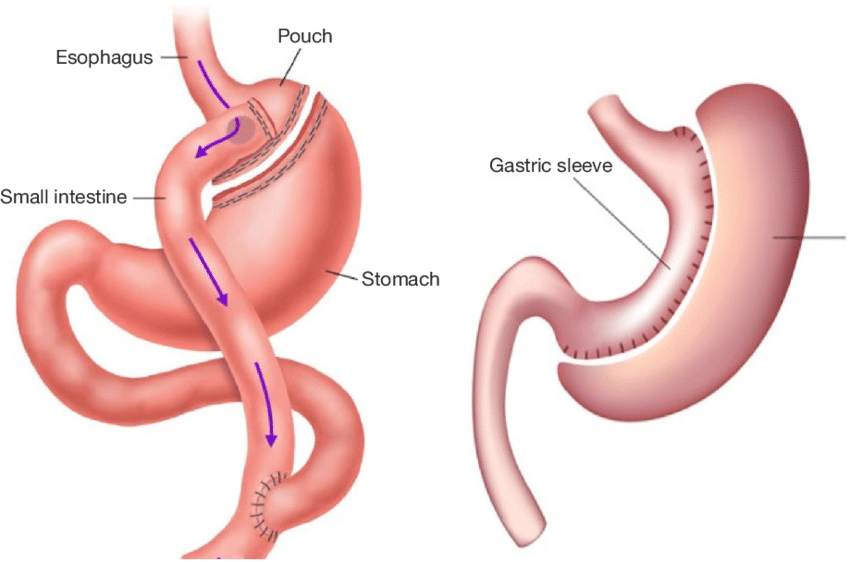 gastric sleeve cost